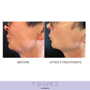 t-shape before and after face