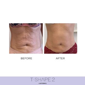 t-shape before and after abdomen