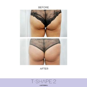 t-shape before and after 